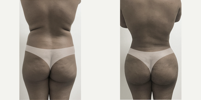 25-34 year old woman treated with Brazilian Butt Lift, Liposuction - Lipo with Fat Transfer (BBL)