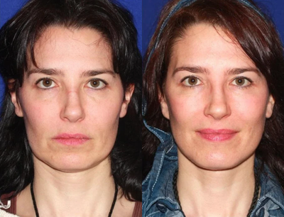 45-54 year old woman treated with Mini Lift - This patient presented for a mini facelift. She was concerned with early aging changes including the jowls and some loose skin under the chin. Early aging changes were reversed with her rejuvenation procedure.