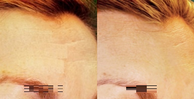 Woman treated with Pelleve - Woman treated with Pelleve