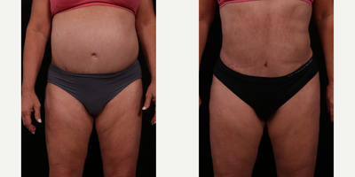 55-64 year old woman treated with Tummy Tuck Revision - revision abdominoplasty