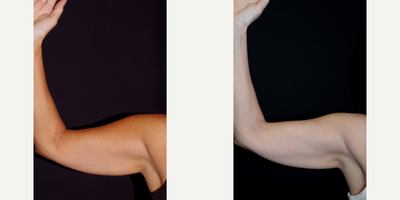 45-54 year old woman treated with Venus Legacy (and CoolSculpting) - 48 year old female received CoolSculpting and Venus Legacy to the arms; photos depict the patient's results 6 months post-CoolSculpting and 3 months post-Venus Legacy.