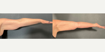Woman treated with Vaser Liposuction - Woman treated with Vaser Liposuction- 6 months post-op