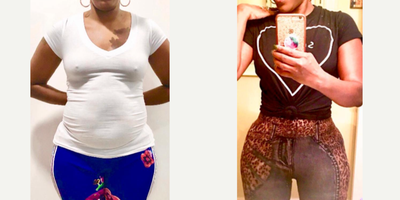 25-34 year old woman treated with Tummy Tuck, Liposuction, Brazilian Butt Lift - Excellent outcome after full body intense liposuction including abdomen, waist, laterals, upper and lower back plus DOMINICAN BUTT LIFT by Mallol getting better volume, contour and butt projection.