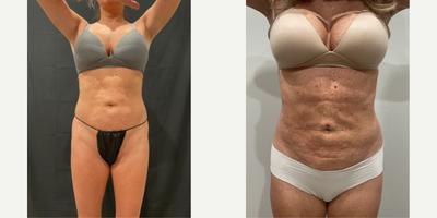 35-44 year old woman treated with Funsculpting Liposuction - Treatment of Abs for Funsculpting