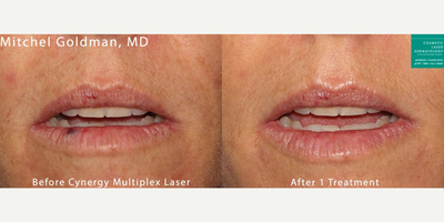 Woman treated with YAG Laser - Cynergy laser to treat venous lake on the lip
