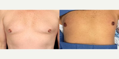 60 year old man treated with Nipple Reduction Surgery - 60 year old man treated with Nipple Reduction Surgery