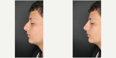 17 or under year old man treated with Nonsurgical Nose Job, Dermal Fillers, Juvederm, Restylane, Restylane Lyft - Non surgical nose enhacenment with filler