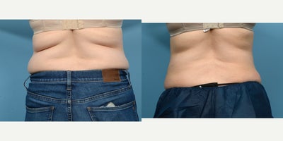45-54 year old woman treated with Cryolipolysis - This 45-year-old patient was treated with one session of CoolSculpting for the flanks, which are often also referred to as love handles. In her case, four applicators were needed to target each individual bulge. Four months post-treatment, she loves the slimmer appearance of her back.