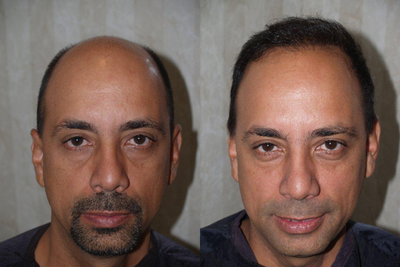 Hair Transplant - 3400 grafts - 
	Hair transplant procedure of 3400 grafts
