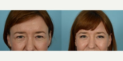 45-54 year old woman treated with Brow Lift - Woman treated with Brow Lift and Eyelid Surgery