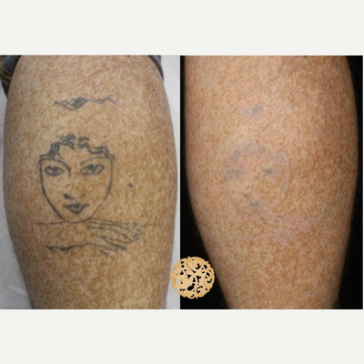 35-44 year old woman treated with PicoSure - Results after one Picosure tattoo removal.