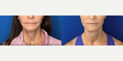 Woman treated with Sofwave - Photo provided courtesy of Sofwave, performed by Sanctuary Medical Center