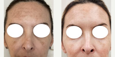 45-54 year old woman treated with Sylfirm X, Chemical Peel - A series of 4 Nano peels for Melasma , plus Alastin Skincare and 2 SylfirmX sessions
