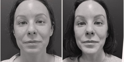 Woman treated with Jaw Surgery - Woman treated with Jaw Surgery.