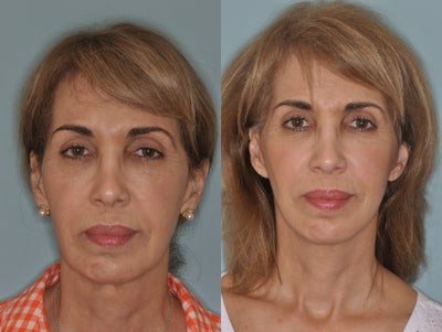 Facelift - 	Facelift before and after.