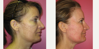 35-44 year old woman treated with Deep FX - 1 month post 1 treatment