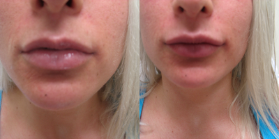 25-34 year old woman treated with Lip Augmentation - Lip augmentation with Restylane Lyft