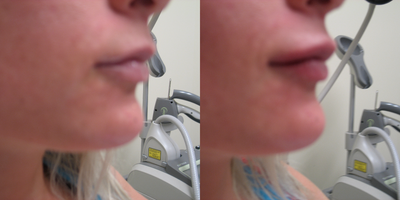25-34 year old woman treated with Lip Augmentation - Restylane Lyft