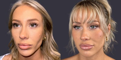 25-34 year old woman treated with Eyelid Surgery, CO2 Laser, ActiveFX - This 30 year old woman is 5'5 and 135 pounds. She presented requesting an eyelid lift. She had an upper eyelid blepharoplasty and and CO2 laser resurfacing of her lower eyelids and crows feet area.