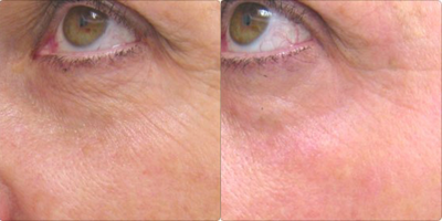 Pixel Laser - Woman treated with Pixel Laser