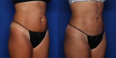 35-44 year old woman treated with Liposculpture - 37 year old female shown 6 weeks after BodyTite liposuction to her abdomen and flanks (lipo 360). She had 1.5 L removed.