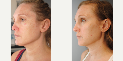 35-44 year old woman treated with Vampire Facial - Vampire Facial, Neck, Chest Series and Revision SkinCare 38yoF The power of coupling medical grade skin treatments with medical grade products is REAL!  Look at the before and after pictures for our gorgeous patient who underwent a Vampire series of her face, neck, and chest.  The treatments combine microneedling with her own platelet rich plasma (PRP).  Head over to the Regenerative Aesthetics part of our website to learn more.  This patient also used the Revision Skin Care line for her daily regimen in between treatments.  Notice the improved overall skin texture, acne, more uniform skin tone and luminosity!  Shes practically glowing in her after pictures. Contact us at 203-221-0102 today for your skincare and Vampire consultation!