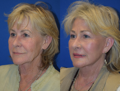 A-Lift, Brow Lift, Lip Lift, Renuvion Skin Resurfacing - A-Lift, Brow Lift, Lip Lift, Renuvion Skin Resurfacing