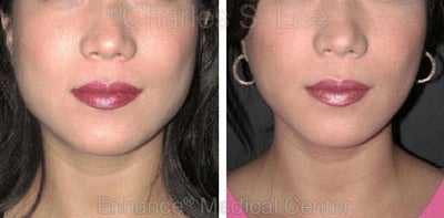 Jaw - 	Non-surgical Jaw Reduction