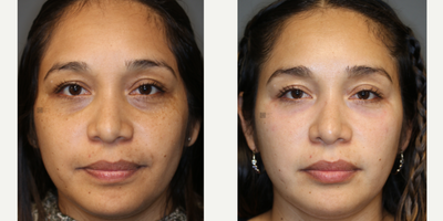 Syringoma Laser Treatment and Lower Lid Filler - Lower eyelid bumps (syringomas) and full facial laser with lower lid filler.