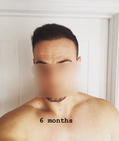 Hair Of Istanbul Hair Transplant On 16th April 2018 Review