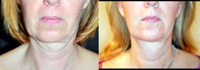 50 Year Old Female treated with Ultherapy for sagging Neck - 
	2 Years Post 2 Ultherapy treatments.
