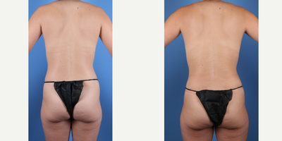 30 year old woman treated with Mommy Makeover, Tummy Tuck, Vaser Liposuction, Liposculpture, Liposuction, Breast Augmentation, B - Dr. Sukkar preformed a customized Mommy Makeover that consisted of a LipoAbdominoplasty (Tummy Tuck w/Liposuction) and a Breast Augmentation on this 30 year old patient. HT: 5'8 WT: 137lbsSientra Silicone Breast Implants High Profile 415 cc (Rt/Lt)Implant Placement: Subpectoral Incision approach: Inframammary Fold