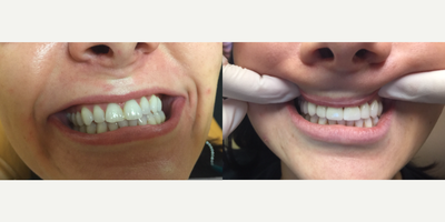 25-34 year old woman treated with Porcelain Veneers for whiter teeth - This was not a very dramatic case, but this patient wanted a brighter, whiter smile that looked as beautiful as her natural teeth. After two appointments with Dr. Sarah Thompson, the patient's teeth are now permanently white with porcelain (e.max) veneers. As long as this patient takes normal care of her teeth, she will have a bright-white smile that lasts her a lifetime.