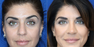 Woman treated with Rhinoplasty - Rhinoplasty