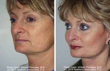 Cheek and Chin Implants, Neck Lift - Cheek and Chin Implants, Neck Lift