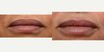 35-44 year old woman treated with Restylane - lip fillers with Radhika, the nurse practitioner at Wise Med Spa