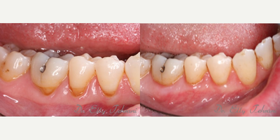 Recession on the lower right - Roots exposure on the lower right treated with connective tissue graft technique (gingival graft).