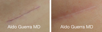 18-24 year old woman treated with Embrace Scar Therapy - Breast augmentation with MemoryGel breast implants under the breast crease incisions. Close up photo of the incisions treated with embrace Active Scar Defense shown at 4 months.