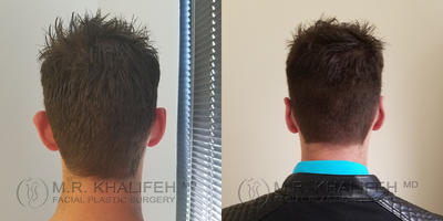 Man treated with Ear Surgery - Awake 3 hour local aneshtesia otoplasty consisting of mustarde and conchomastoid suturing to reshape the ear.