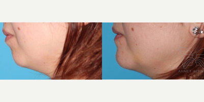 Woman treated with Chin Liposuction - Woman treated with Chin Liposuction