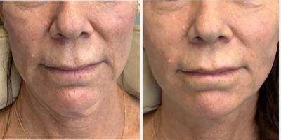 55-64 year old woman treated with Contour Thread Lift - 57 year old female - requesting improvement of fine lines around mouth (nasolabial lines, oral commissures).   Pt received Sculptra 1 vial plus PDO Threads (18g Infiniti Plus Molded PDO threads).  Immediate untouched after photos.
