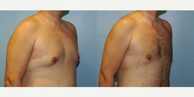 Male Breast Reduction - Gynecomastia: gland removal