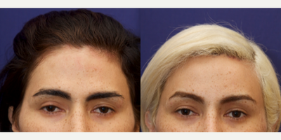 Transgender woman treated with Forehead Reduction - Transgender woman treated with Forehead Reduction