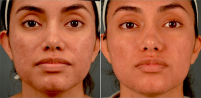 25-34 year old woman treated with Venus Viva - Venus Viva fractional radiofrequency/RF treatment is fantastic for facial resurfacing (wrinkles, sun spots, crepe skin, fine lines, pore reduction, and texture improvements), scars, and melasma. Since it is not a laser it can be used on all skin types (including darker skin and sensitive skin like those with eczema and/or rosacea). It is also fantastic for acne, as it helps the topical medications used to treat acne to penetrate the skin more readily. Long term tightening and lifting is improved with Venus Viva in combination with other skin tightening procedures such as radiofrequency/RF like Venus Legacy or ultrasound like Ultherapy.