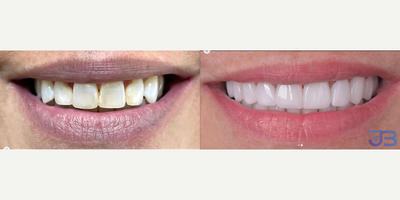 Woman treated with Smile Makeover, Porcelain Veneers - Now her eyes looks brighter than before, thats what a new smile does.
