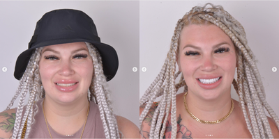 Woman treated with Porcelain Veneers, Smile Makeover - Woman treated with Porcelain Veneers, Smile Makeover