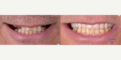 Man treated with All-on-4 Dental Implants - All on 4 Acrilic Overdenture