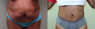 45-54 year old woman treated with Tummy Tuck - Abdominoplasty patient before and after photos