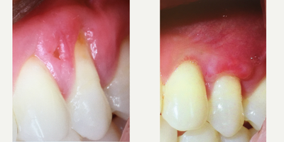 25-34 year old woman treated with Gingival Graft - Connective tissue graft
