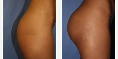 25-34 year old woman treated with Butt Implants - 460cc buttock implants.